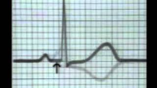 Learning ECG  WPW Syndrome [upl. by Kehsihba]