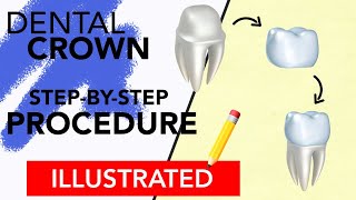 Dental Crown StepByStep Procedure Illustrated [upl. by Islek]