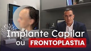 IMPLANTE CAPILAR X FRONTOPLASTIA qual melhor opção para reduzir a testa em mulheres [upl. by Marwin]