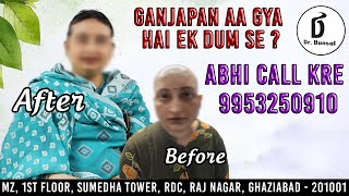 ganjepan ka ilaz Alopecia ka kya ilaz hai Alopecia kya hai  baal kyu girte hai  Dandruff [upl. by Enywtna]