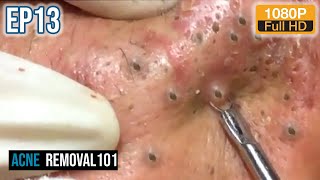 Cystic Acne Extraction 32mn  Blackheads Removal by ACNEREMOVAL101 [upl. by Atnuahsal]