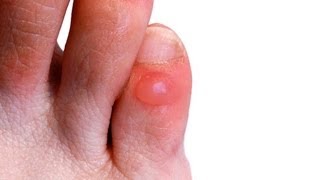 What Causes Blisters On Feet [upl. by Noired]