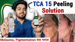 Tca 15 Chemical Peel Review  TCA 15 Peel How to Use  At Home Chemical Peel [upl. by Dibrin834]