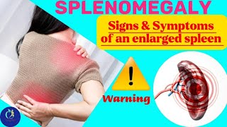 SPLENOMEGALYEnlarged SpleenSymptoms of an enlarged spleen Such as anemia abdominal painetc [upl. by Ecirted]