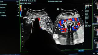 Nuchal Cord sonography [upl. by Gary383]