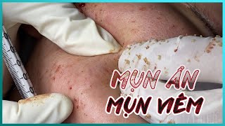 Big Cystic Acne Blackheads Extraction Blackheads amp Milia Whiteheads Removal Pimple Popping [upl. by Novihs]