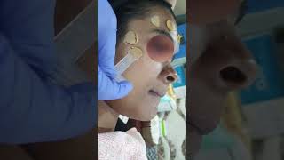 Cosmelan Peel at Reincarnation Skin Clinic by Dr Priyanka Aggarwal [upl. by Bathesda247]