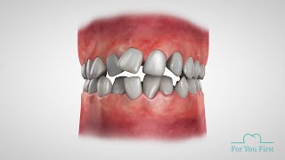 3D Animation showing teeth movements [upl. by Ahselat686]