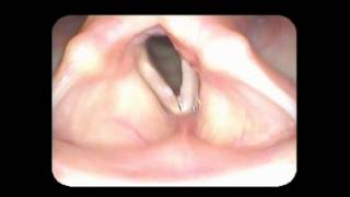 Vocal cord paralysis with nodules [upl. by Ecnarretal173]