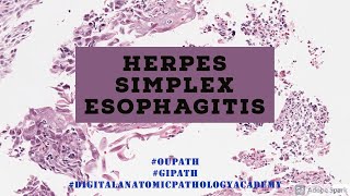 Herpes Esophagitis [upl. by Assilym]