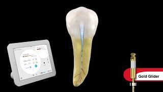 Endodontic Canal Preparation with Dr Ruddle [upl. by Atikin191]