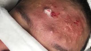 Under Skin Severe Acne Removal On Face [upl. by Anol396]