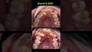 Cost  2500 for this case Braces crooked teeth braces orthodontist dentist [upl. by Cully981]