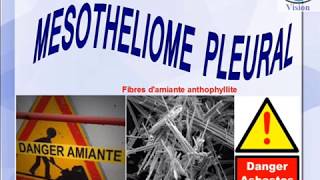 Mésothéliome pleural et les Produits contenant de lAmiante [upl. by Sanalda]