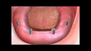 Implant Supported Dentures [upl. by Strephon]