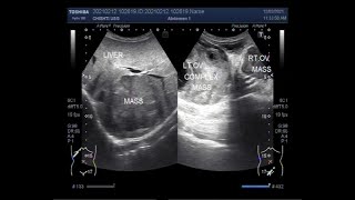 Multiple findings including Hepatic Mass Splenic Masses complex Ovarian Cyst and Ovarian Mass [upl. by Rudwik326]