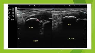 Osteochrondrose du cartilage de croissance en échographie [upl. by Gar190]