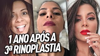 1 ANO APÓS A 3ª RINOPLASTIA CIRURGIA PLÁSTICA NO NARIZ [upl. by Llerihs]