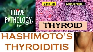 HASHIMOTOS THYROIDITIS Etiopathogenesis Morphology amp Complications [upl. by Nitza]