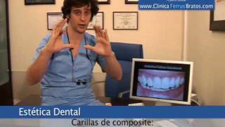 Blanqueamiento dental con Carillas de composite [upl. by Standice700]