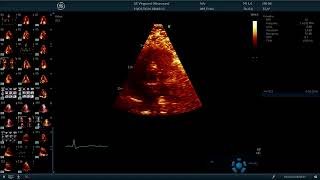 〖Echocardiography〗 Handson parasternal short axis PSAX  all views amp measurements 💫 💟 [upl. by Kcirdot]