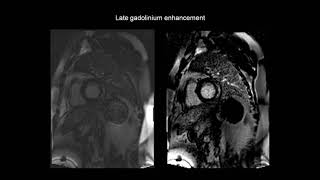 How to assess myocarditis with the help of cardiac MRI CMR [upl. by Saphra]