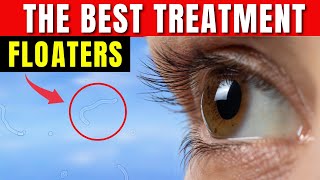 How to Get Rid of Eye Floaters  Eye Floaters Best Natural Treatment [upl. by Giacopo]