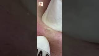 Blackheads Removal  Acne Treatment and Very Satisfying Satisfying Pimple pop blackheads [upl. by Boyse]