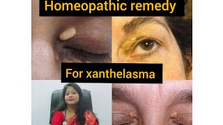 Homeopathic treatment for xanthelasmaPermanent treatment cost effective solution [upl. by Portie]