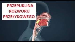 Przepuklina rozworu przełykowego《73》 [upl. by Yolane]