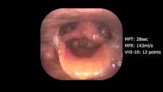 Spasmodic dysphoniaabductor type Post Operative [upl. by Atteuqahc]