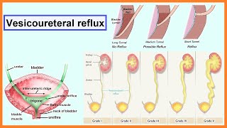 vesicoureteral reflux [upl. by Ano]