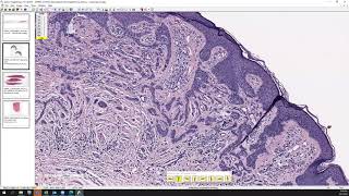 Morpheaform BCC vs desmoplastic trichoepithelioma vs microcystic adnexal carcinoma vs syringoma [upl. by Socrates306]