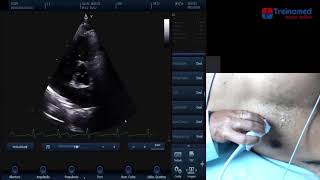 Tutorial Ecocardiograma Normal  Parte 2 [upl. by Aytak113]