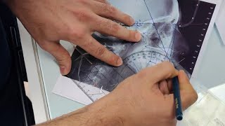Tracing a cephalometric xray for patient has anterior open bite malocclusion [upl. by Noswad]