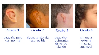 Conocimiento acerca de la Microtia [upl. by Anitap]