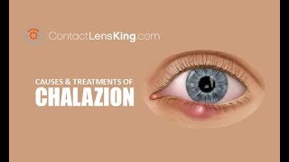 Chalazion  Causes Treatment and Surgery [upl. by Weisbart]