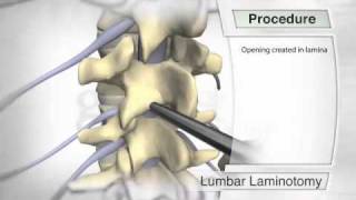 Lumbar Laminotomy Procedure [upl. by Owiat692]