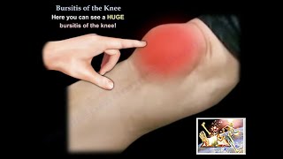 Knee Bursitis  Everything You Need To Know  Dr Nabil Ebraheim [upl. by Sommer]