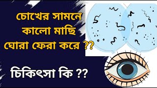 What are Floaters in eyes causes and treatment  Vitreous floaters eye eyefloaters eyeflashes [upl. by Eedeed]