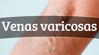 Venas varicosas  Síntomas y recomendaciones [upl. by Lleznol]