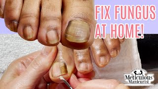 Toenail Fungus Cleaning at Home Success [upl. by Tristas]