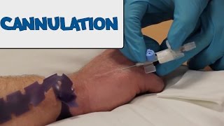 How to Perform Cannulation  OSCE Guide old version  UKMLA  CPSA [upl. by Kiersten978]