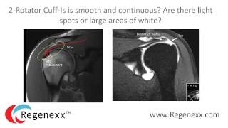 How to read your shoulder MRI with Dr Centeno of Regenexx [upl. by Hoffarth783]