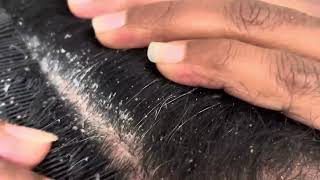 Dandruff scratching flakes  Hair Wash after end of video [upl. by Neeluqcaj]