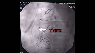 Angioplastia a Coronaria derecha En paciente con bypass [upl. by Kandy]