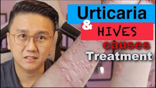 URTICARIA amp HIVES  Causes and Treatment of Itchy Skin Rash [upl. by Sulienroc761]