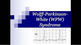 ECG Tip 19 What happens with WPW to look like this in ECG [upl. by Inaoj]