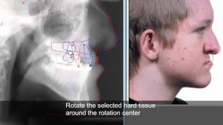 Treatment planning and soft tissue prediction 9 with Facad software [upl. by Aneeuqahs]