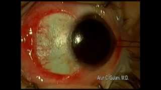 Pinguecula Surgery Cosmetic outcomes with DrGulani  Gulani Vision [upl. by Amery612]